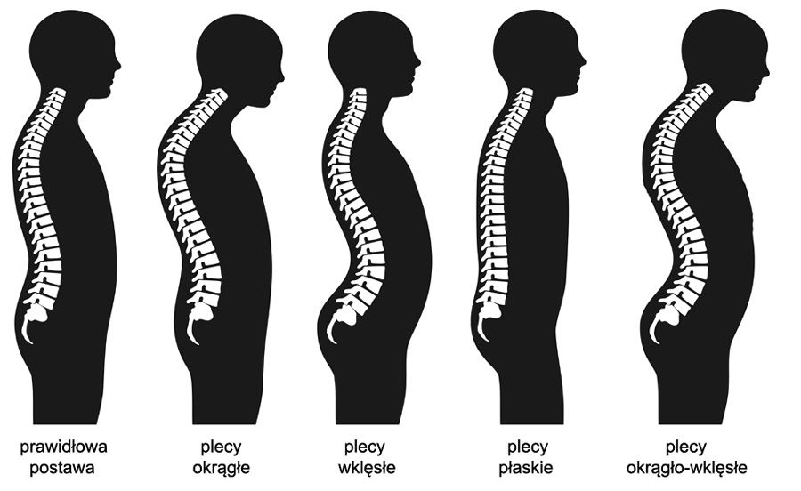 Wady postawy – rozpoznanie, leczenie i ćwiczenia wzmacniające kręgosłup